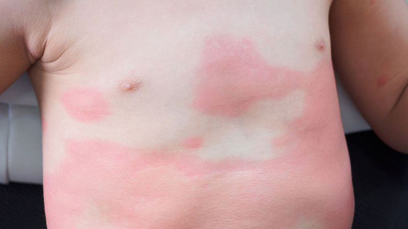 Lapsen rintakehä, jossa on selviä nokkosihottumaläiskiä